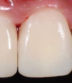 After composite filling